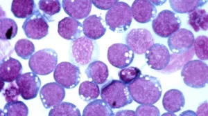 Epstein-Barr Virus (EBV) 